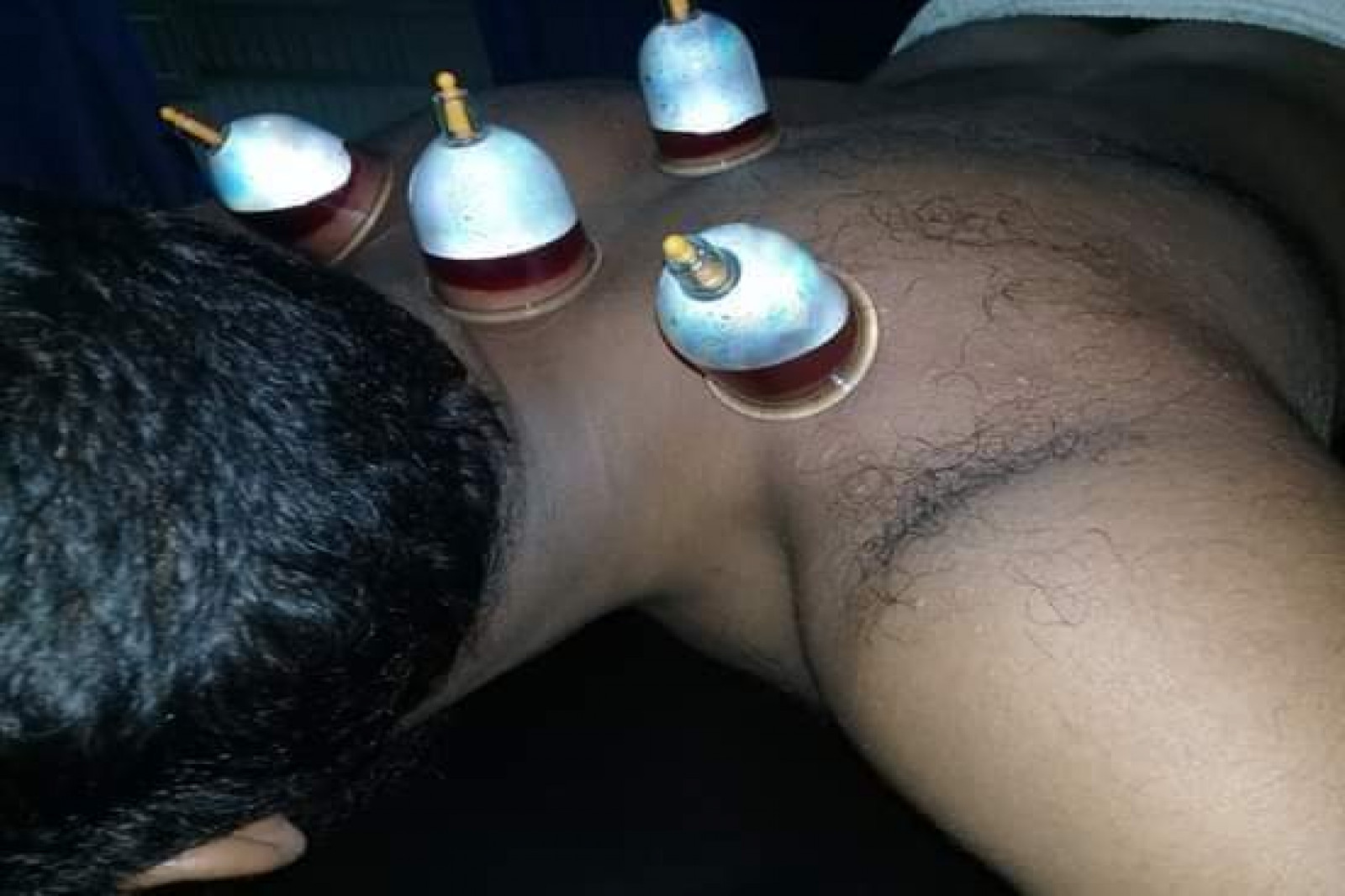 Hijama therapy /cupping therapy